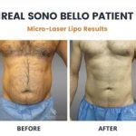 how expensive is sonobello|sono bello breast reduction cost.